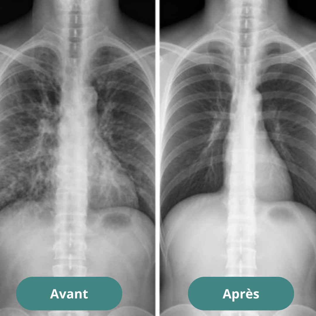 Anti-cigarette | Collier respiratoire